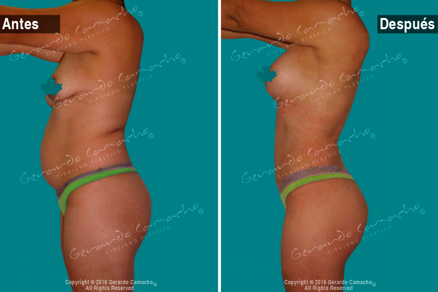 Senos y abdomen remodelados con Mommy Makeover en Bogotá